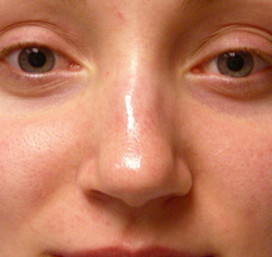 rhinoplasty before photo by michigan cosmetic surgery in southfield mi