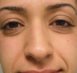rhinoplasty before photo by michigan cosmetic surgery in southfield mi