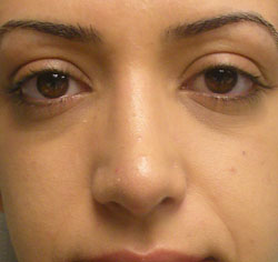 rhinoplasty after photo by michigan cosmetic surgery in southfield mi