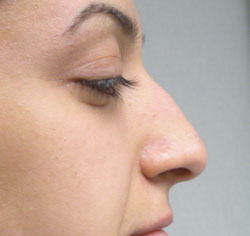 rhinoplasty before photo by michigan cosmetic surgery in southfield mi
