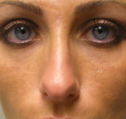 rhinoplasty before photo by michigan cosmetic surgery in southfield mi
