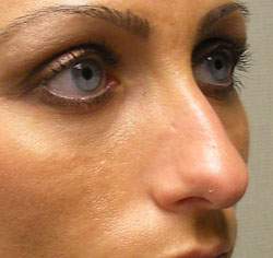 rhinoplasty before photo by michigan cosmetic surgery in southfield mi