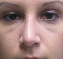 rhinoplasty after photo by michigan cosmetic surgery in southfield mi