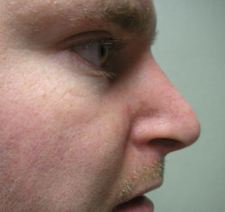 rhinoplasty after photo by michigan cosmetic surgery in southfield mi