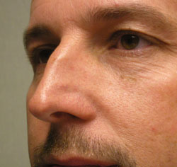 rhinoplasty before photo by michigan cosmetic surgery in southfield mi