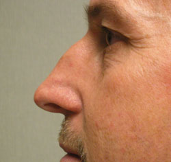 rhinoplasty before photo by michigan cosmetic surgery in southfield mi