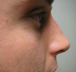 rhinoplasty after photo by michigan cosmetic surgery in southfield mi