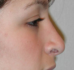 rhinoplasty after photo by michigan cosmetic surgery in southfield mi