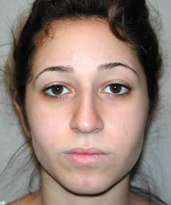 rhinoplasty before photo by michigan cosmetic surgery in southfield mi