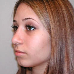 rhinoplasty after photo by michigan cosmetic surgery in southfield mi