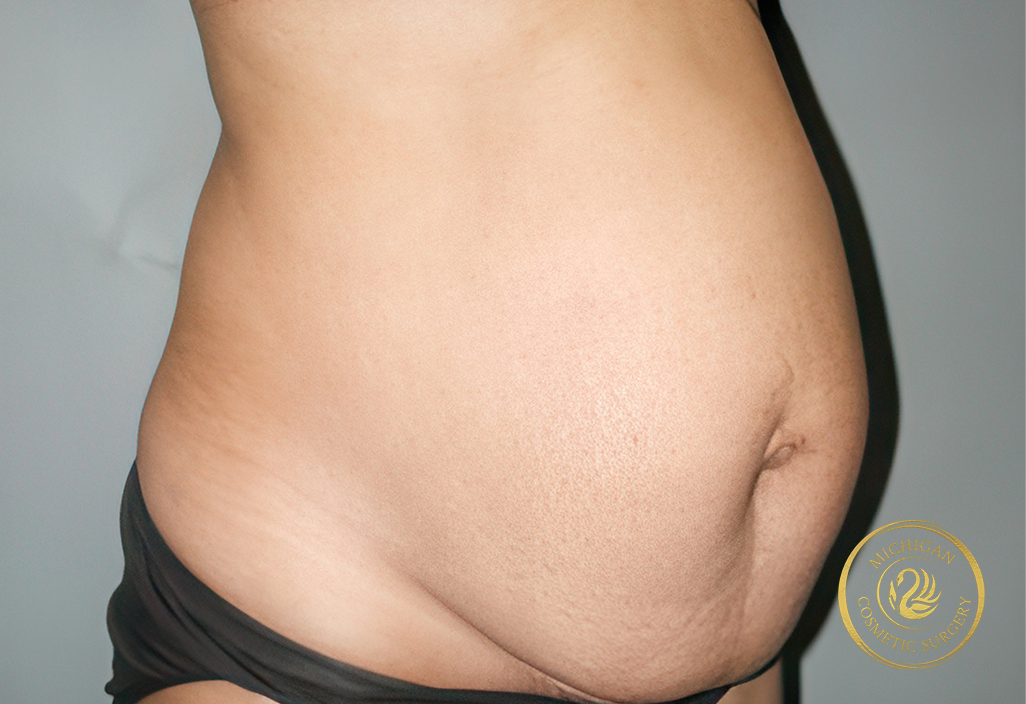 tummy tuck before photo by michigan cosmetic surgery in southfield mi