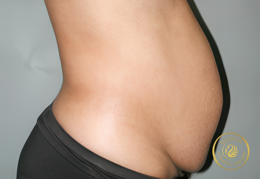 tummy tuck before photo by michigan cosmetic surgery in southfield mi