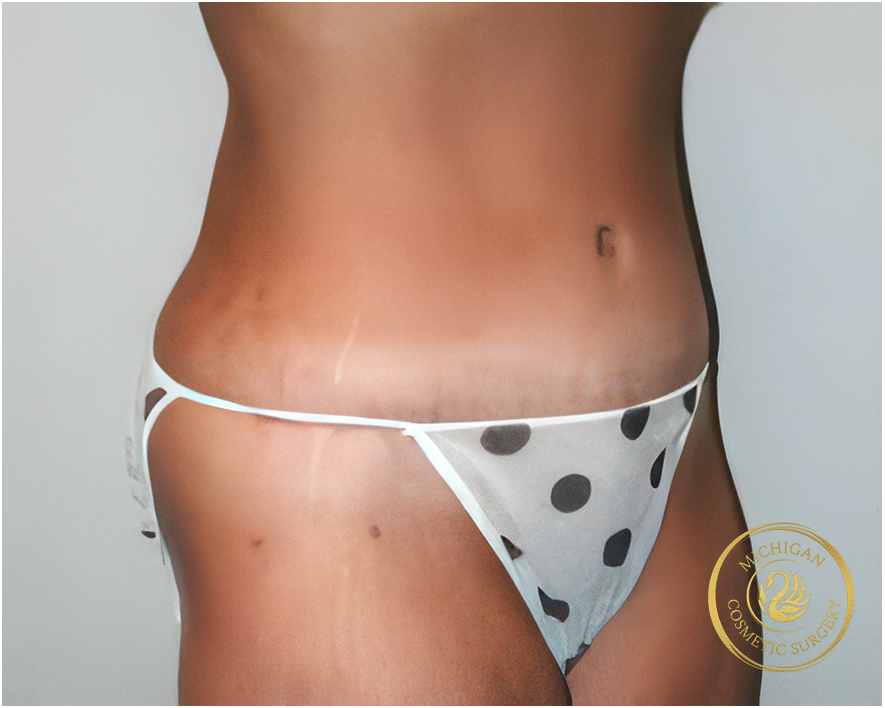 tummy tuck after photo by michigan cosmetic surgery in southfield mi