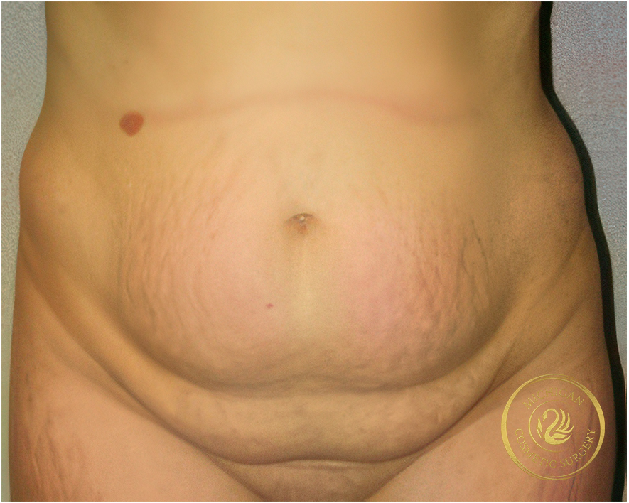 tummy tuck before photo by michigan cosmetic surgery in southfield mi