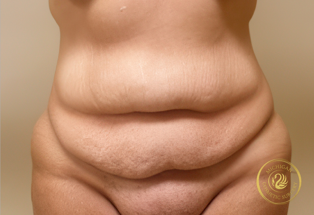 tummy tuck before photo by michigan cosmetic surgery in southfield mi