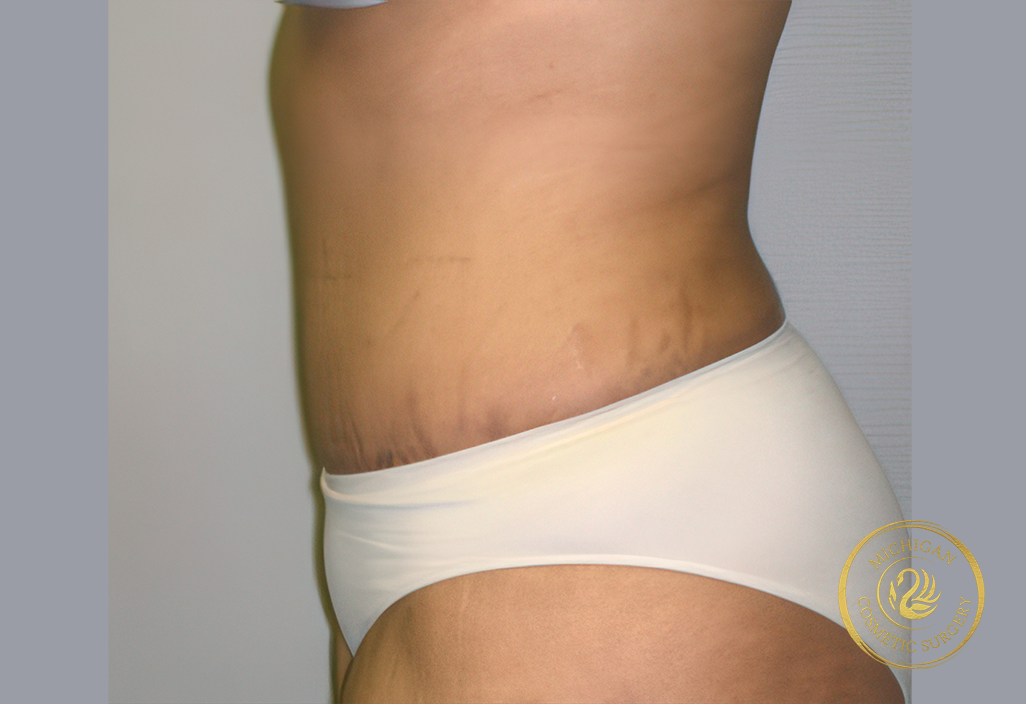 tummy tuck after photo by michigan cosmetic surgery in southfield mi