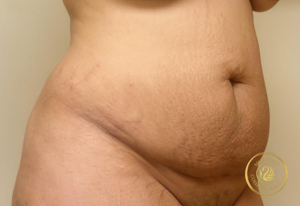 tummy tuck before photo by michigan cosmetic surgery in southfield mi