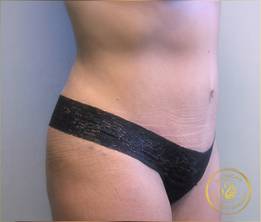 tummy tuck after photo by michigan cosmetic surgery in southfield mi