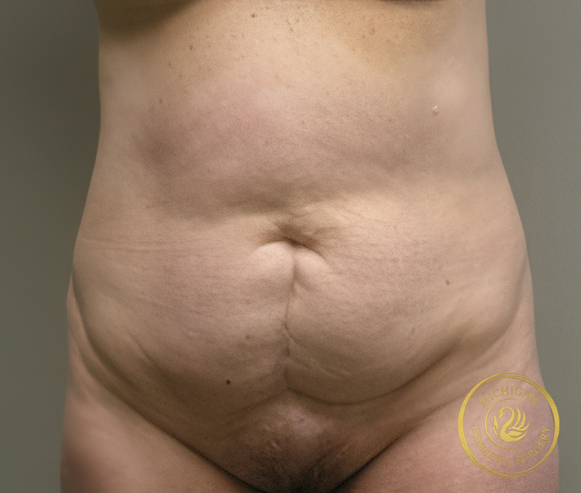 tummy tuck after photo by michigan cosmetic surgery in southfield mi tummy tuck before photo by michigan cosmetic surgery in southfield mi