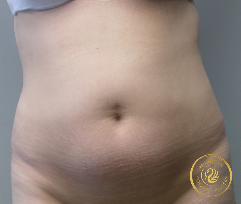tummy tuck before photo by michigan cosmetic surgery in southfield mi tummy tuck before photo by michigan cosmetic surgery in southfield mi