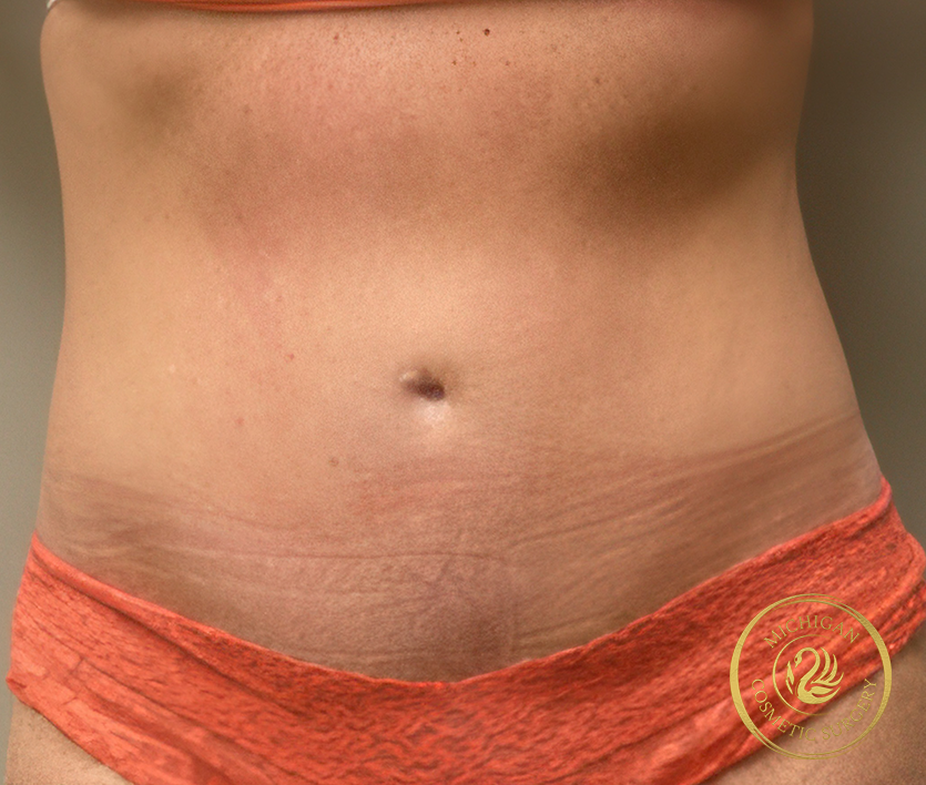 tummy tuck before photo by michigan cosmetic surgery in southfield mi