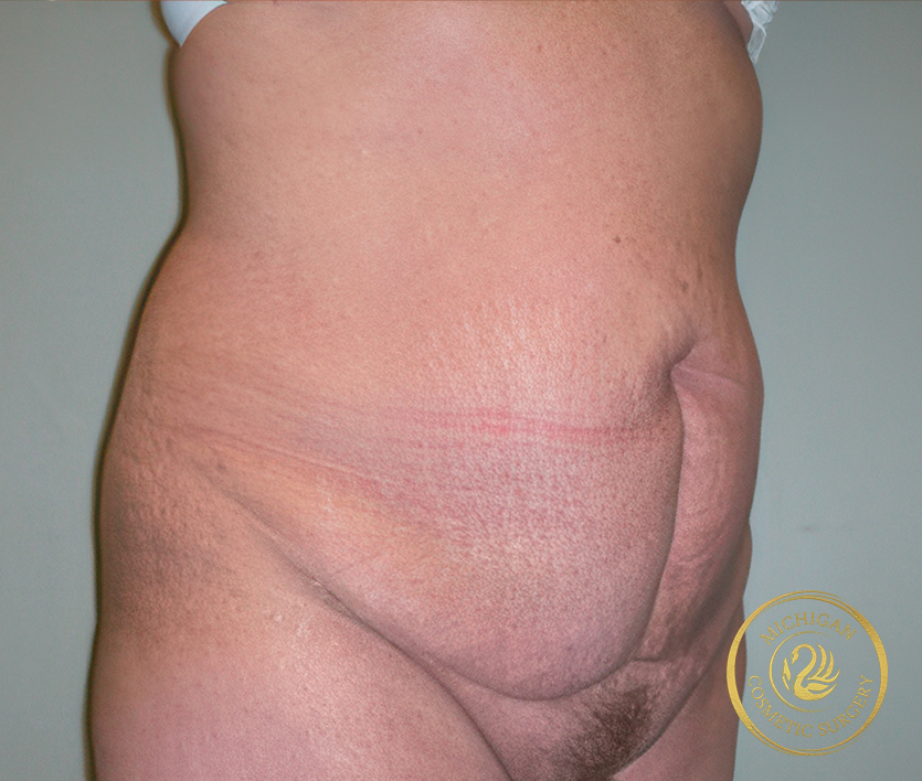 tummy tuck before photo by michigan cosmetic surgery in southfield mi