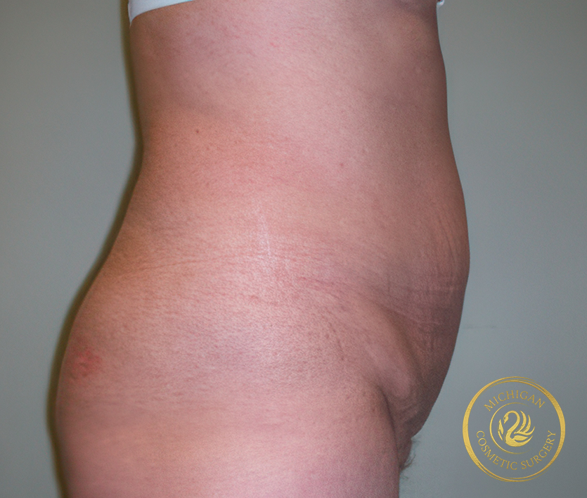 tummy tuck before photo by michigan cosmetic surgery in southfield mi