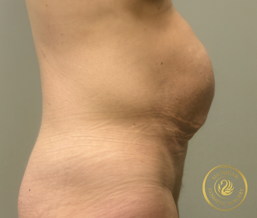 tummy tuck before photo by michigan cosmetic surgery in southfield mi