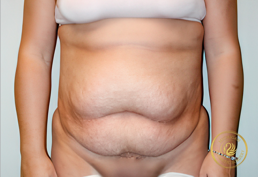 tummy tuck before photo by michigan cosmetic surgery in southfield mi