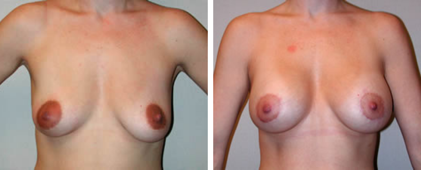 Breast Aug Crescent Periareolar lift a
