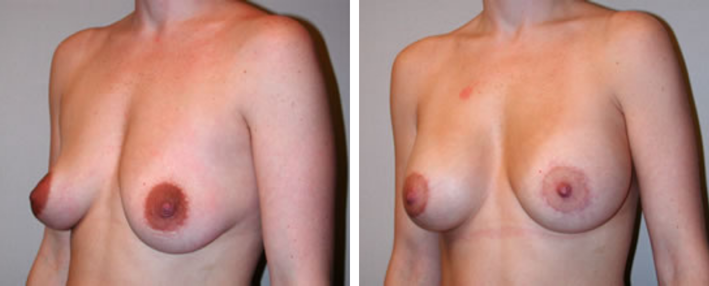 Breast Aug Crescent Periareolar lift b