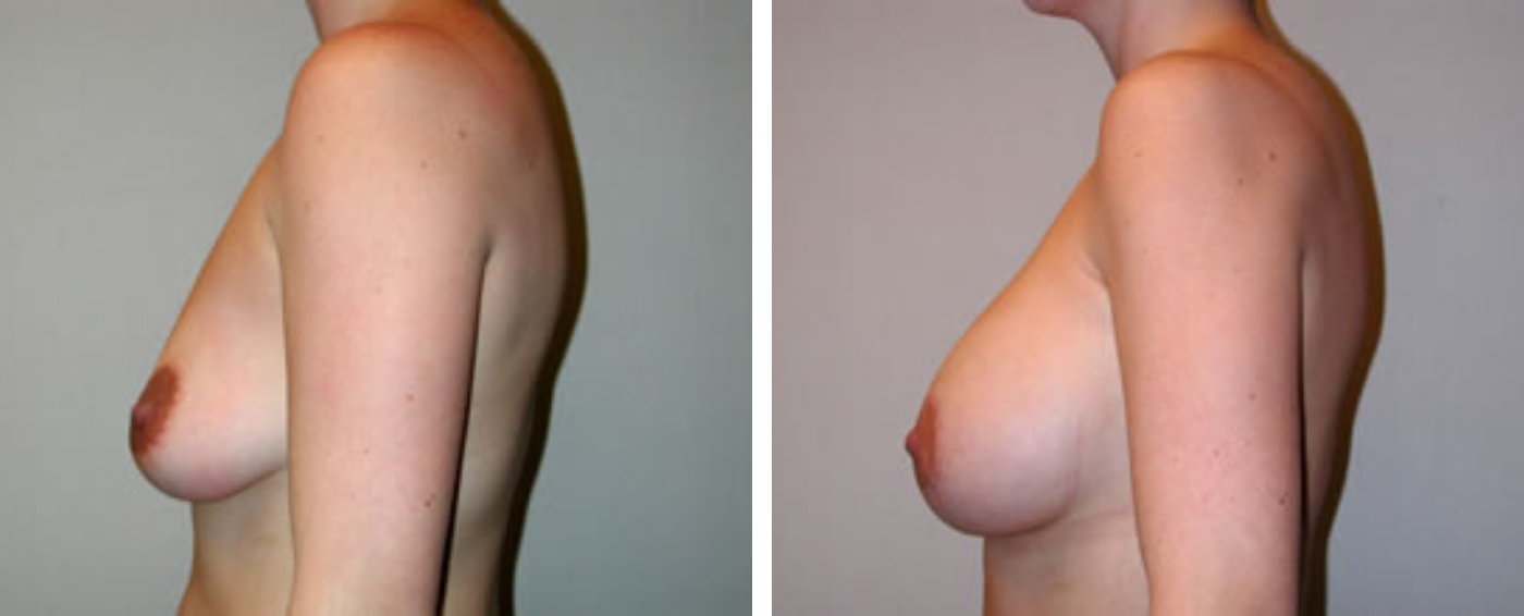 Breast Aug Crescent Periareolar lift c