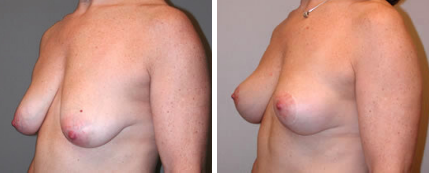 Breast lift b