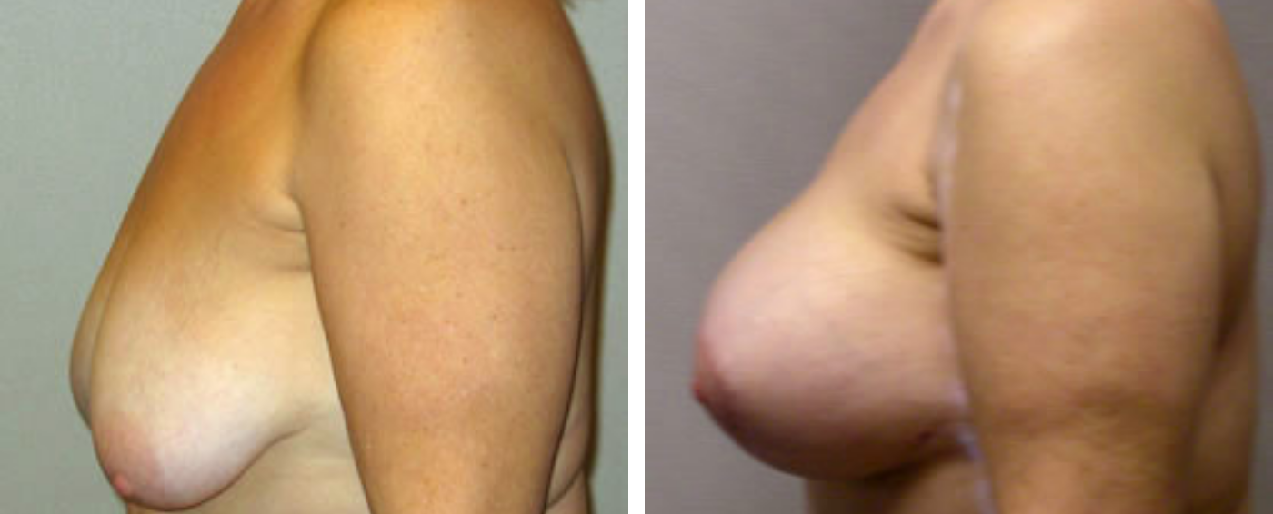 Breast Augmentation with Lollipop Lift b