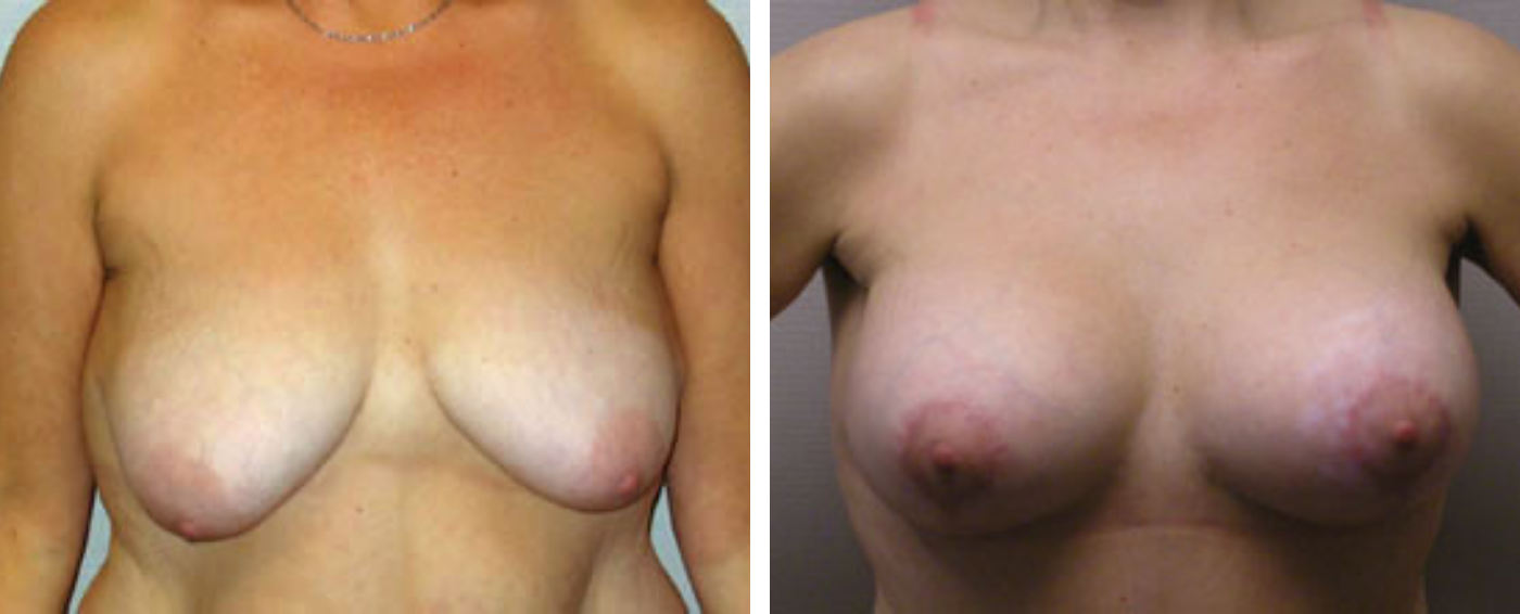 Breast Augmentation with Lollipop Lift c