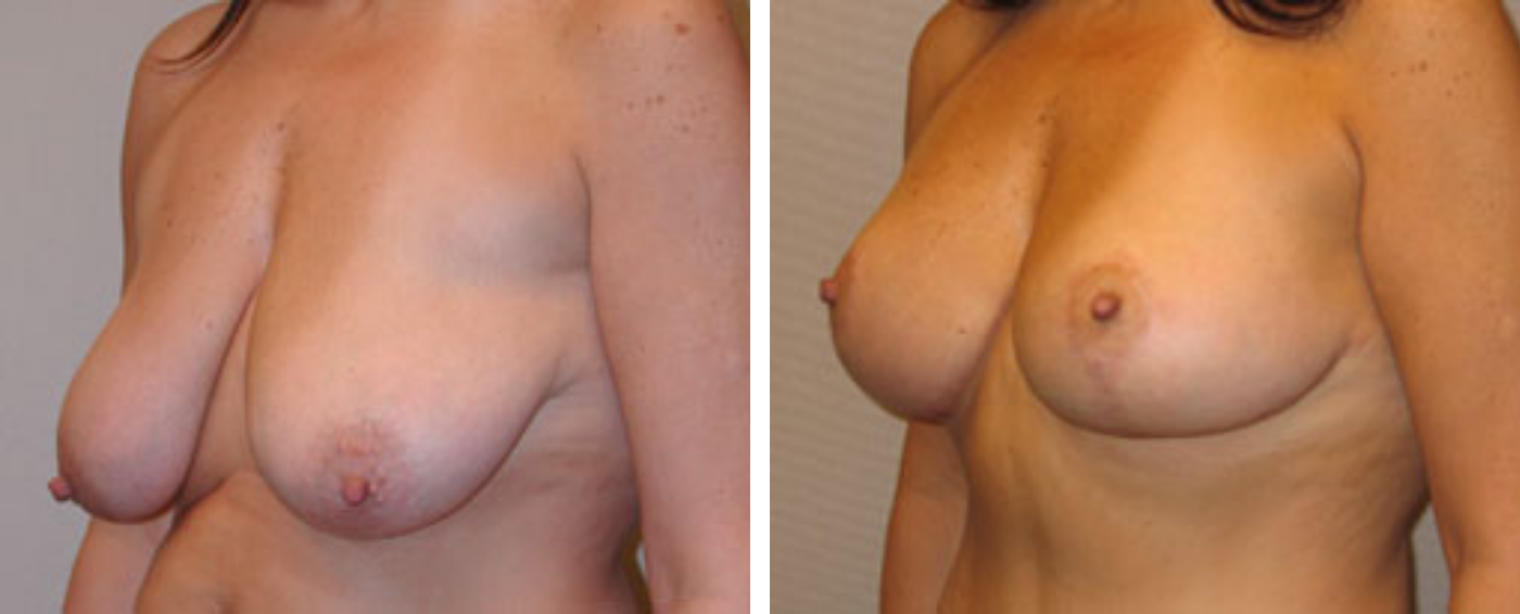 Breast lift b