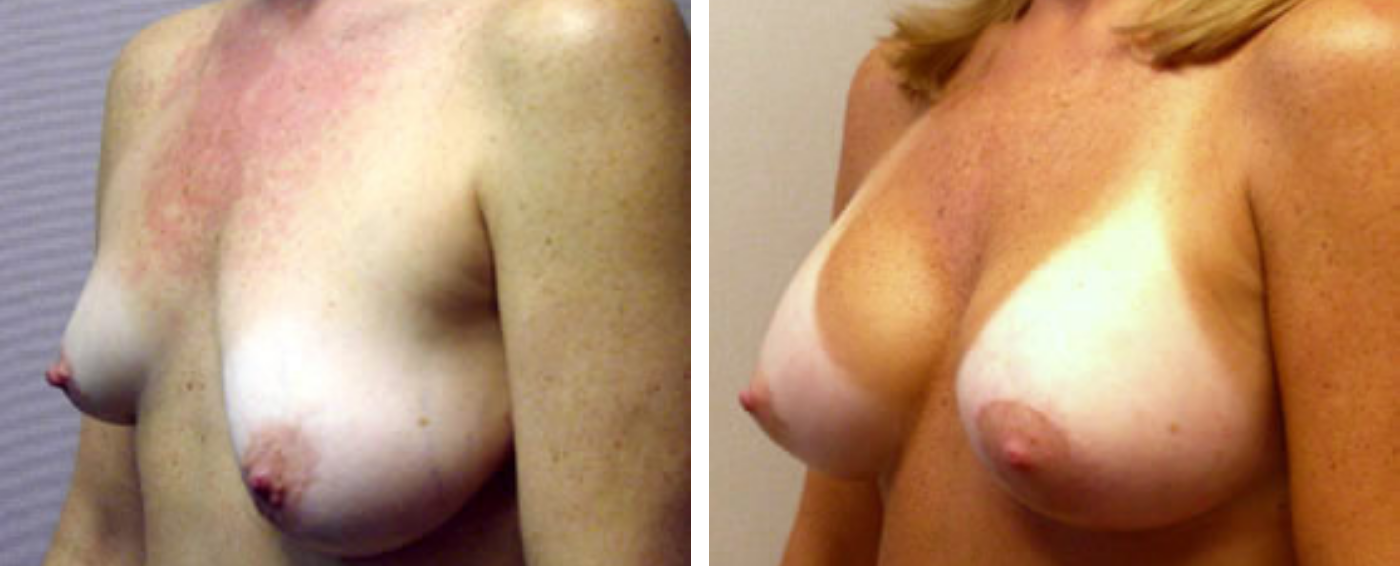 Breast Aug Periareolar lift b