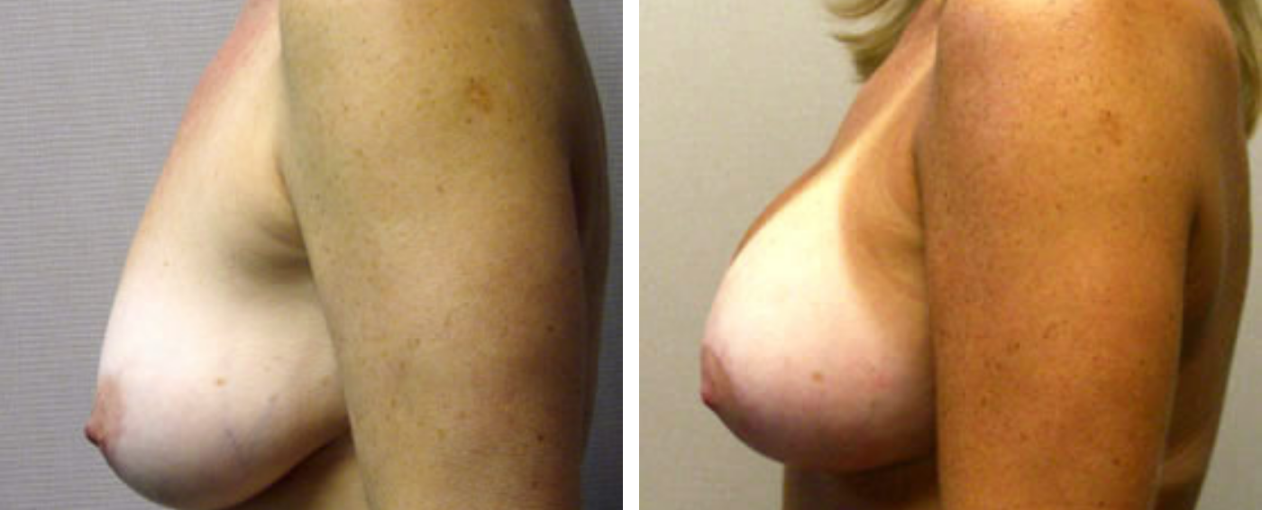 Breast Aug Periareolar lift c