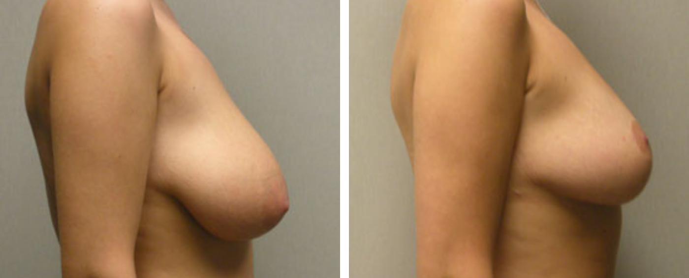Breast lift c