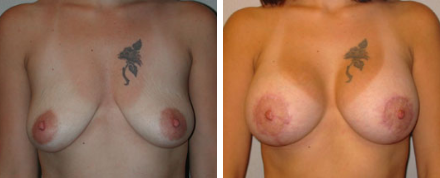 Breast Aug Periareolar lift a