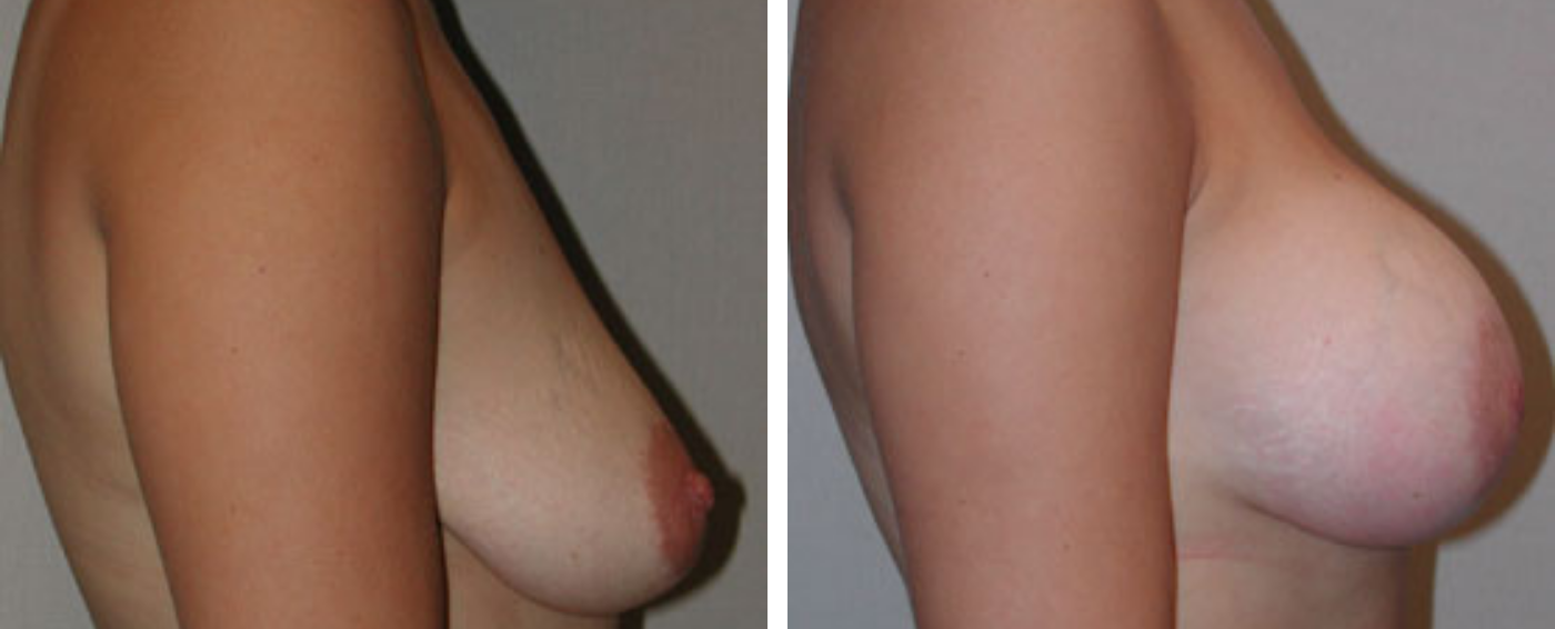 Breast Aug Periareolar lift c