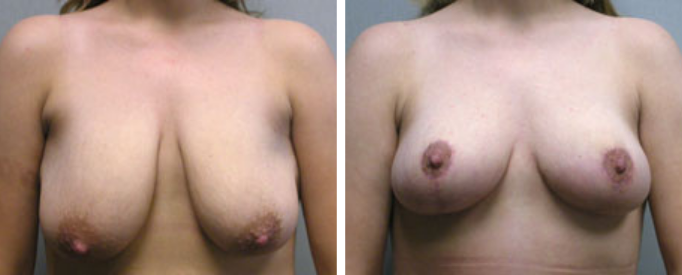 Breast lift a