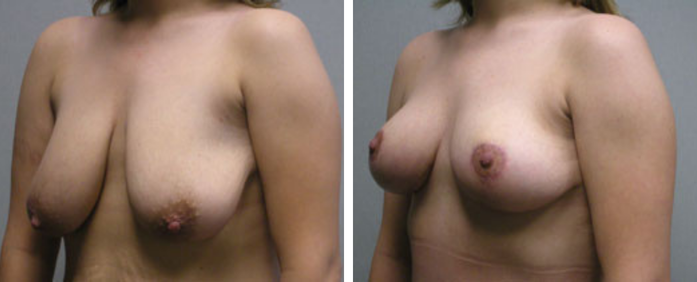 Breast lift b