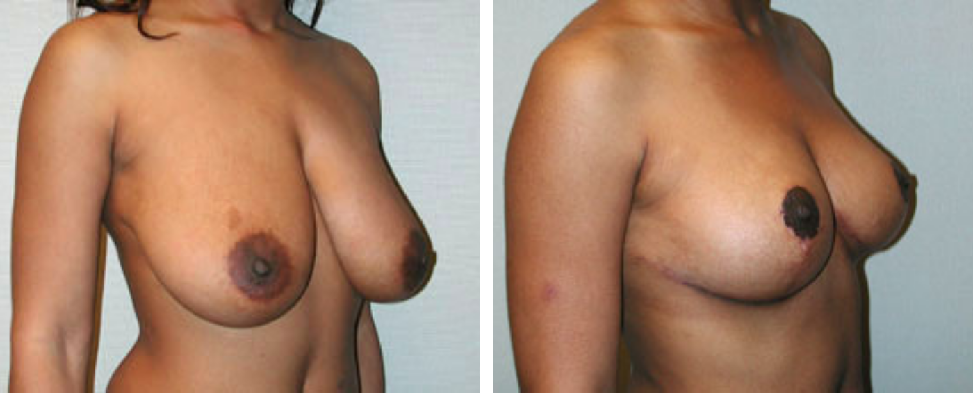 Breast Reduction C (Angle)