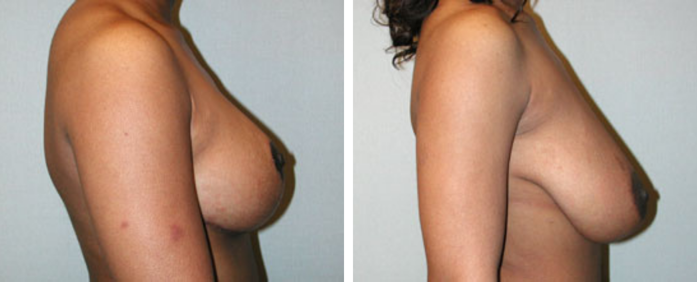 Breast Reduction C (Side)