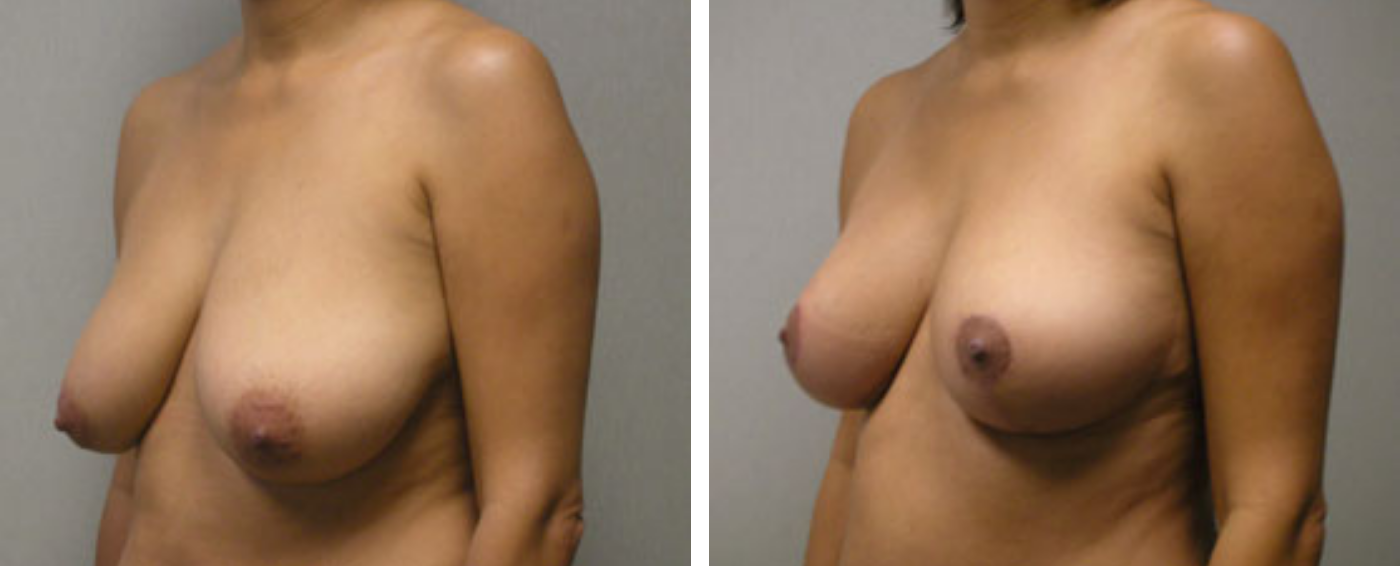 Breast lift b