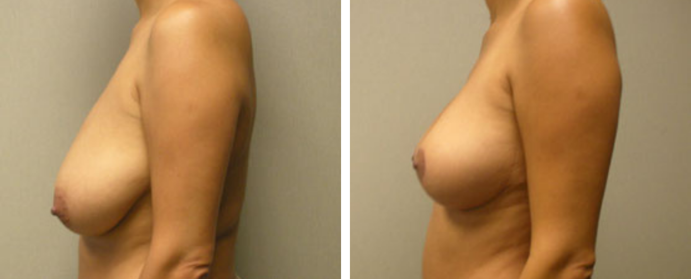 Breast lift c