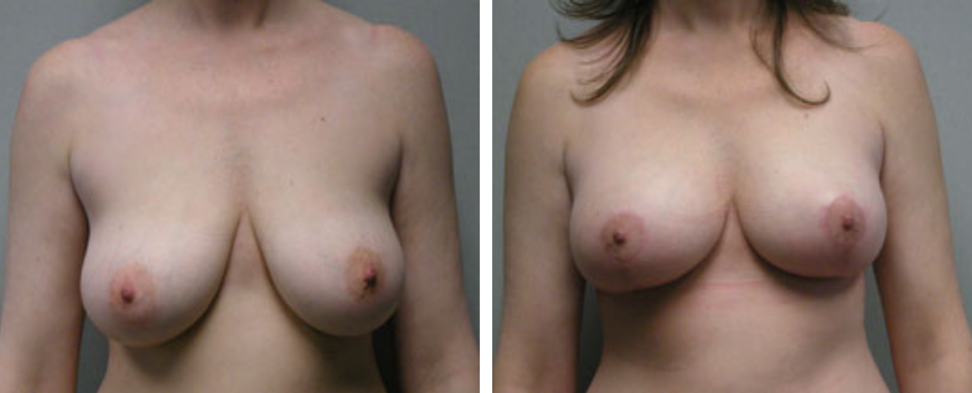 Breast lift a
