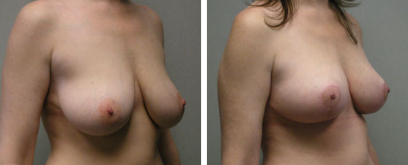 Breast lift b