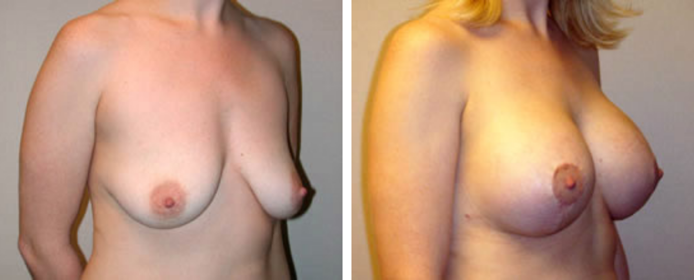 Breast Augmentation with Lollipop Lift b